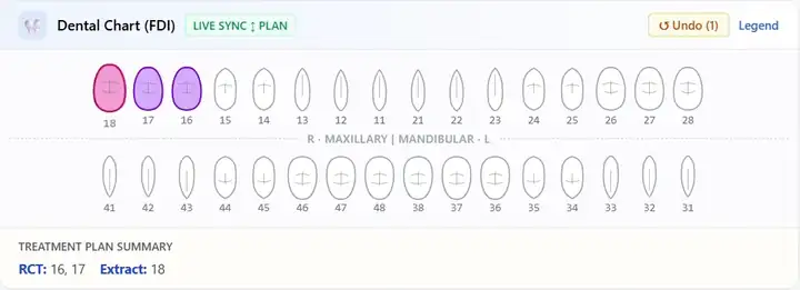 FDI dental chart with teeth 16 and 17 marked for RCT and 18 marked for extraction.